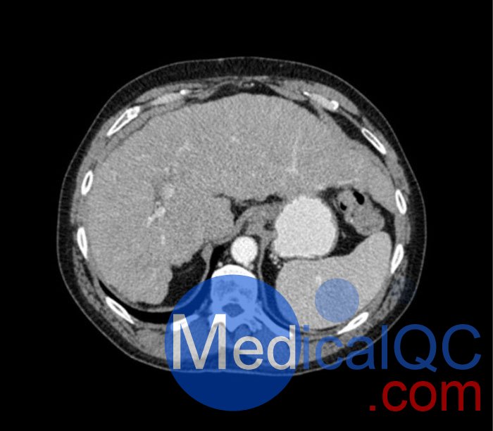 WEK53-04肝硬化腹部模体,WEK53-04门静脉期腹部模体产品成像图